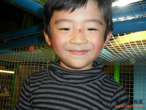 Lucas鼻梁被刮伤